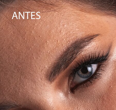 Retoque de pele, antes